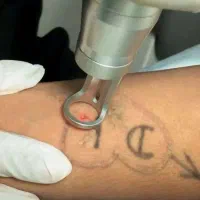 پاکسازی و رفع تتو خالکوبی کک ومک