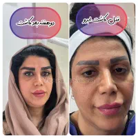 کاشت ابرو نچرال
