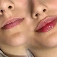 تخفیف ویژه تزریق ژل و بوتاکس ۱۲۰۰