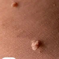 زگیل داری درمانش اینجاست