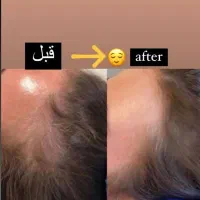 مشاور پوست و مو لیاتیم|آرایشی، بهداشتی، درمانی|اصفهان, باغ زرشک|دیوار
