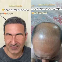 کاشت مو قسطی شد