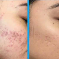 فشیال تخصصی vip پوست به مدت 3 روز فقط 170 تومن