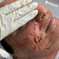 اولین درمانگرلک با متدپکینگ آپ وحذف تک جلسه کک مک