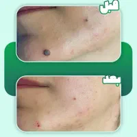 حذف خال، کک و مک و زوائد پوستی با کمترین قیمت|خدمات آرایشگری و زیبایی|یاسوج, |دیوار