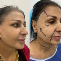 لیفت شقیقه و صورت|خدمات آرایشگری و زیبایی|اهواز, کیان اباد|دیوار