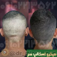 اسکالپ سر آقایان