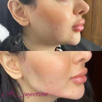 آموزش و تزریق ژل و بوتاکس|خدمات آرایشگری و زیبایی|مسجد سلیمان, |دیوار