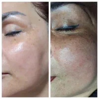 فشیال درمانی‌ رفع ۷۰ درصد اختللات پوستی|خدمات آرایشگری و زیبایی|رشت, دیلمان|دیوار