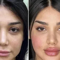 ساکشن چربی و تزریق ژل و بوتاکس و مزو لیفت شقیقه و.|خدمات آرایشگری و زیبایی|کرمانشاه, |دیوار