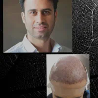 کاشت مو.ابرو.ریش.فول تراکم با شرایط استثنایی