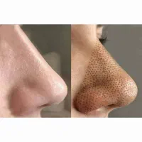 اموزش و خدمات میکرو نیدلینگ