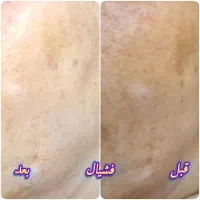 پاکسازی و جوانسازی پوست....و کاشت وترمیم ناخن|خدمات آرایشگری و زیبایی|شهریار, شهریار|دیوار