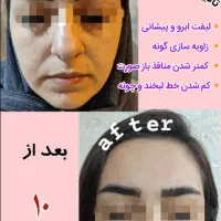 دستگاه جوانساز هایفو صورت و بدن|آرایشگاه و سالنهای زیبایی|اهر, |دیوار