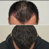 جشنواره لیفت فیلربوتاکس بلفارو نخ تزریق چربی فشیال|خدمات آرایشگری و زیبایی|اصفهان, ملکشهر|دیوار