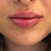 تزریق فیلر وبوتاکس وجوانساز صورت|خدمات آرایشگری و زیبایی|کارون, |دیوار