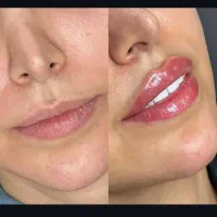 تزریق فیلر و بوتاکس در کلینیک پوست و لیزر سهرابی|خدمات آرایشگری و زیبایی|کرمانشاه, |دیوار