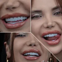 جشنواره دندان ونیر کامپوزیت روکش لمینیت عصب IMAX