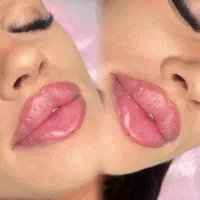 تزریق ژل لب کرج جشنواره عیدانه تزریق فیلر بوتاکس