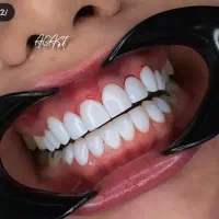 ایمپلنت و کامپوزیت دندان فقط از 10