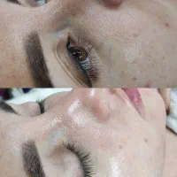 مزونیدلینگ ، PRP ، مزوتراپی صورت و مو