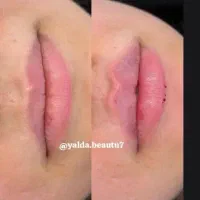 تزریق ژل و بوتاکس