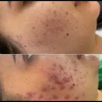 جوانسازی ،درمان پوست ،فیشال،پاکسازی،پوست کره ای|خدمات آرایشگری و زیبایی|شیراز, قدوسی غربی|دیوار