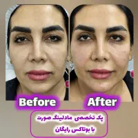ژل بوتاکس لیفت‌ فیلربینی زیرچشم مادلینگ مزو/صادقیه|خدمات آرایشگری و زیبایی|تهران, فدک|دیوار