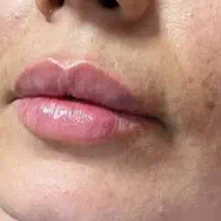 بوتاکسژلنچرالدرمحیط تخصصی کلینیک آموزش۴/۵