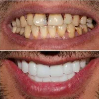 دندانپزشکی عصب کشی ،روکش،ایمپلنت،کامپوزیت|خدمات آرایشگری و زیبایی|بروجرد, |دیوار