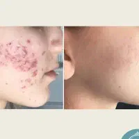 خدمات ژل و بوتاکس  توسط پیراپزشک
