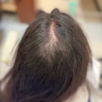 پی ار پی PRP ،مزوتراپی،اگزوزوم ولنجک،زعفرانیه|خدمات آرایشگری و زیبایی|تهران, محمودیه|دیوار