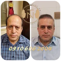 کاشت مو