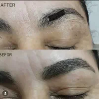 ریمو(پاک کردن)تتو صورت