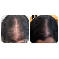 درمان ریزش مو و مشکلات پوستی