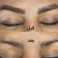 ریموو ابرو با روش های نوین بدون درد و خونریزی