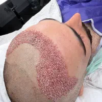 کاشت مو ی پر تراکم|خدمات آرایشگری و زیبایی|ساری, |دیوار