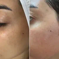 پاکسازی+ درما رایگان (۱۷۵ تومان )در کلینیک پزشک|خدمات آرایشگری و زیبایی|بیرجند, |دیوار