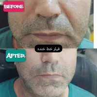 جشنواره بوتاکس/فیلر/مزوتراپی/پی آر پی  توسط پزشک|خدمات آرایشگری و زیبایی|زنجان, |دیوار
