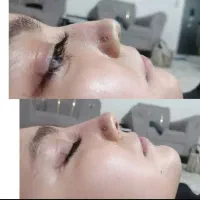 آف ویژه فیلر|خدمات آرایشگری و زیبایی|مشهد, شهید آوینی|دیوار