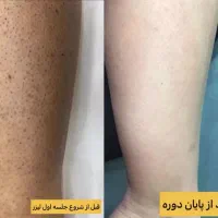 لیزر موهای زائدبا ۷۰درصد تخفیف