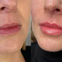 تزریق و آموزش فیلر و بوتاکس با ارائه مدرک|خدمات آرایشگری و زیبایی|کرج, چهارصد دستگاه|دیوار