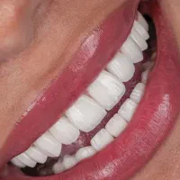 کلینیک دندانپزشکی لبخند سفید،کامپوزیت ،لمینیت