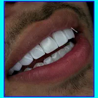 کامپوزیت دندان/ترمیم/دندانپزشکی/بیلچینگ|خدمات آرایشگری و زیبایی|تهران, تهرانپارس غربی|دیوار