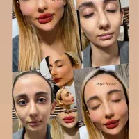 تزریق ژل فیلر بوتاکس تخفیف پاییزی|خدمات آرایشگری و زیبایی|اصفهان, مرداویج|دیوار