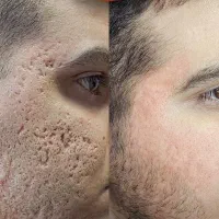 درمان اسکار و جای جوش