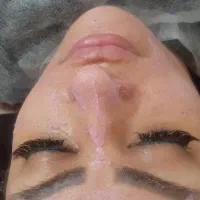 فیشال، پاکسازی پوست