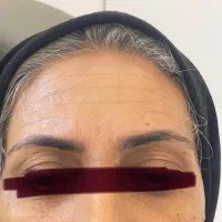 تزریق بوتاکس توسط پزشک