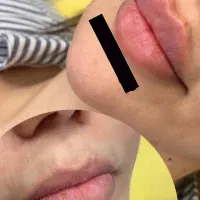 تزریق فیلر و بوتاکس(تخفیفمونو از دست نده)|خدمات آرایشگری و زیبایی|شهریار, شهرک وائین|دیوار