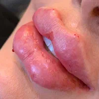 آف ویژه تزریق ژل و بوتاکس تضمینی